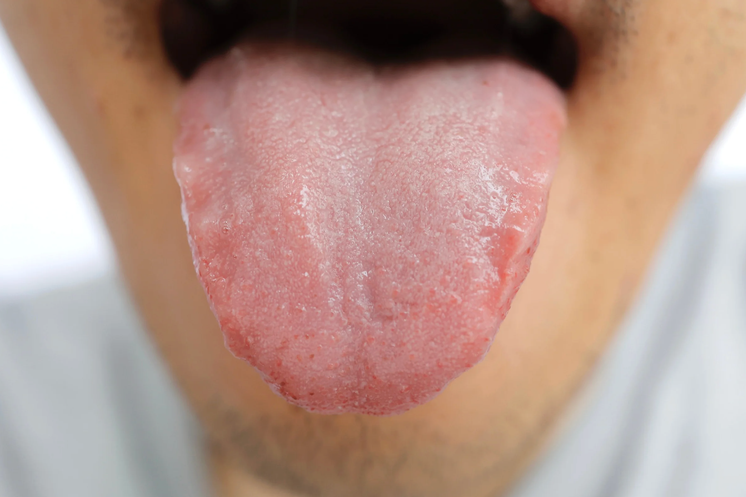 Person sticking out tongue coated in white candida
