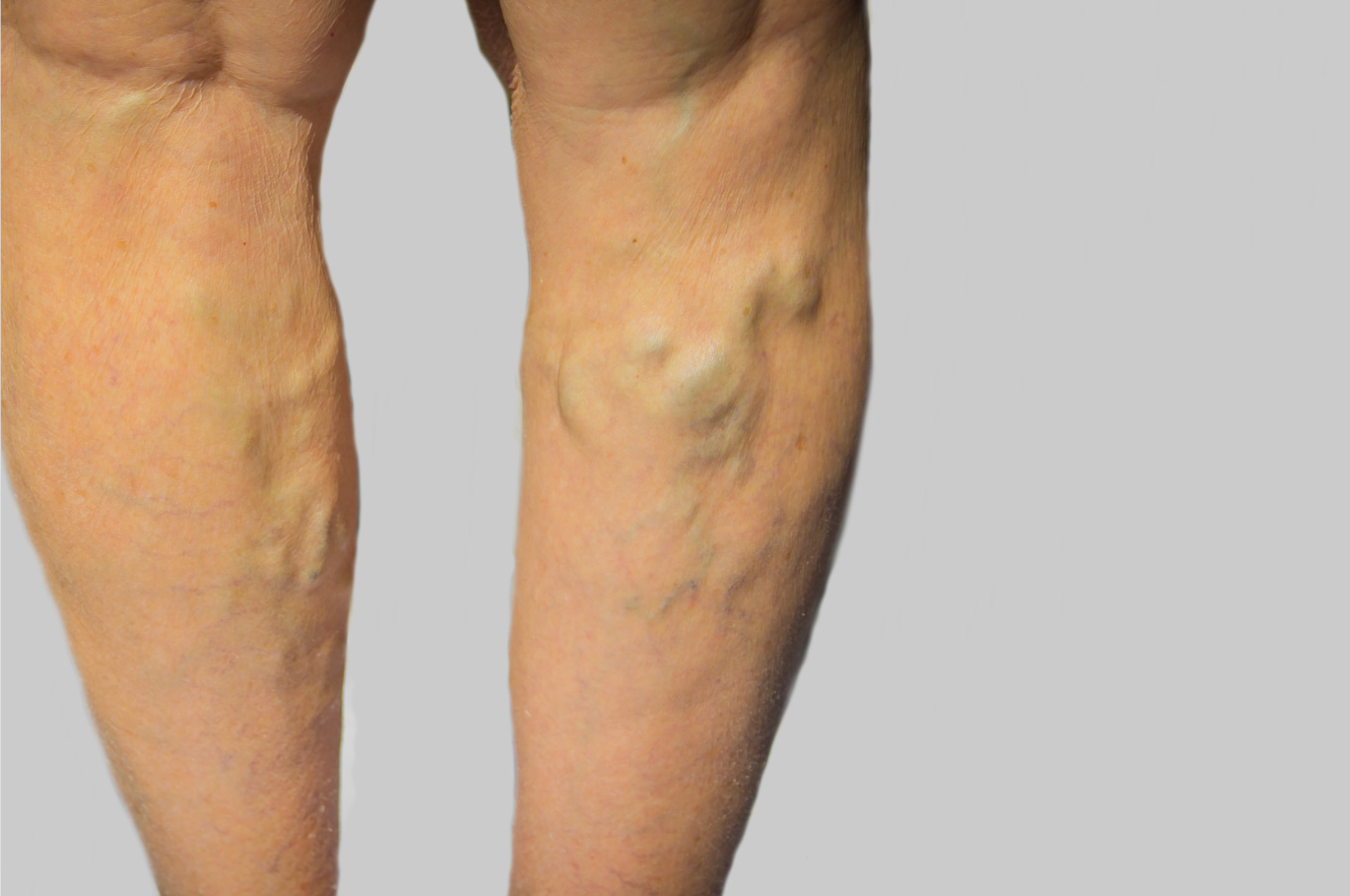 Legs showing varicose veins