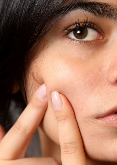 Is Acne due to Sugar, Dairy Products, and Bad Fats?